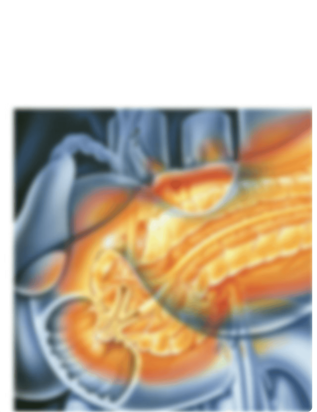 understanding acute pancreatitis_d13lsf7d4g6_page1