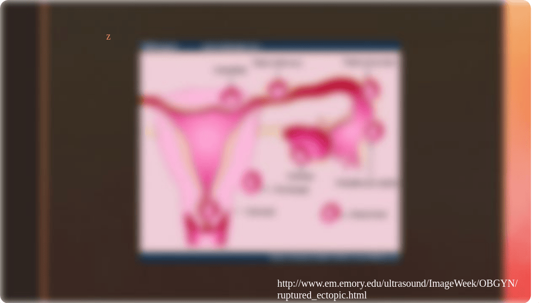 OB Presentation Ectopic Pregnancies.pptx_d4w4o7yvw4u_page3