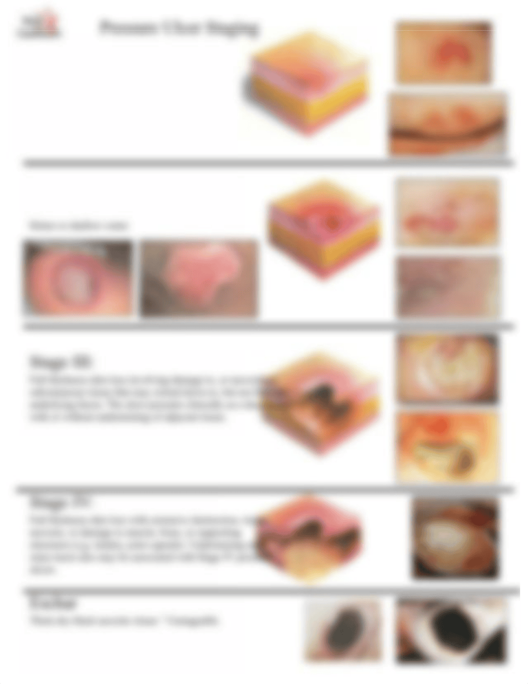 pressure ulcer staging.pdf_d4waoytubju_page1