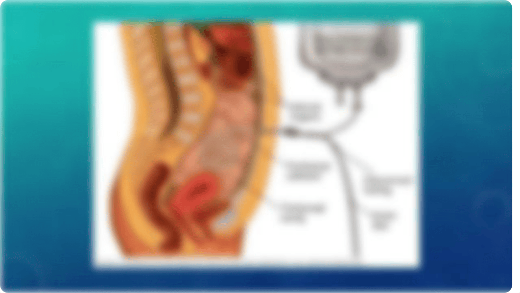 Peritoneal Dialysis.pptx_d58sk4p8u1f_page2