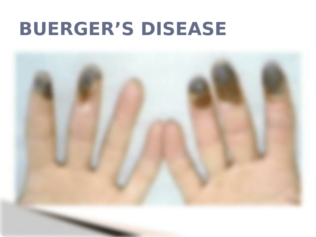 BUERGERS DISEASE (1)(1).pptx_d6x3pra3f9k_page3