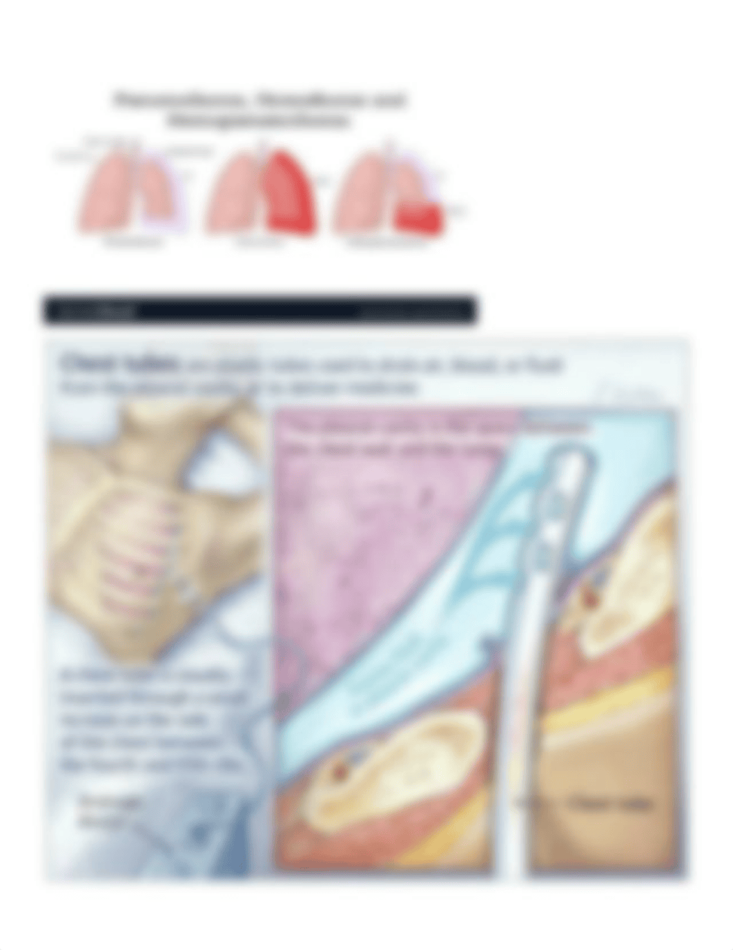 Chest tube Drainage System Monitoring and Care.docx_d7gz7inswdj_page2