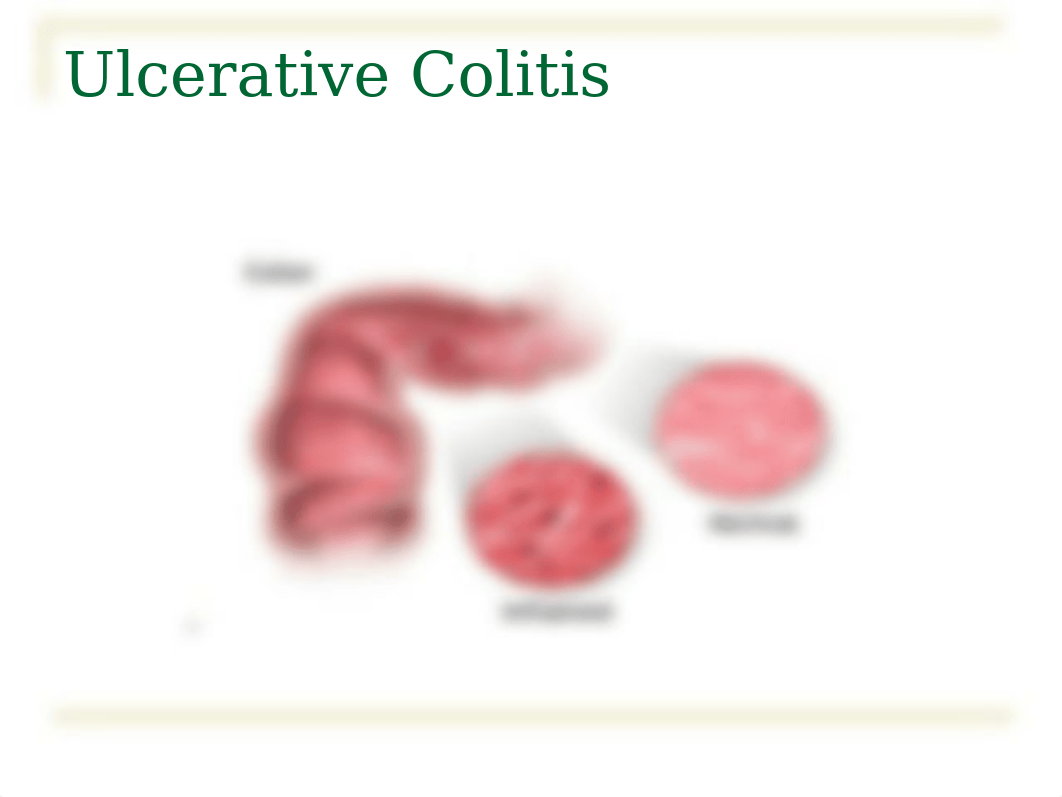 Tutoring 12 Inflammatory Bowel Disease (IBD)[1].ppt, 2008 (1).ppt_d7o5om671f6_page4