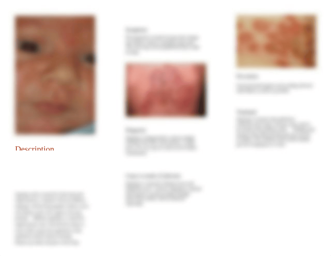 Impetigo Brochure.pptx_d89i65laia6_page2