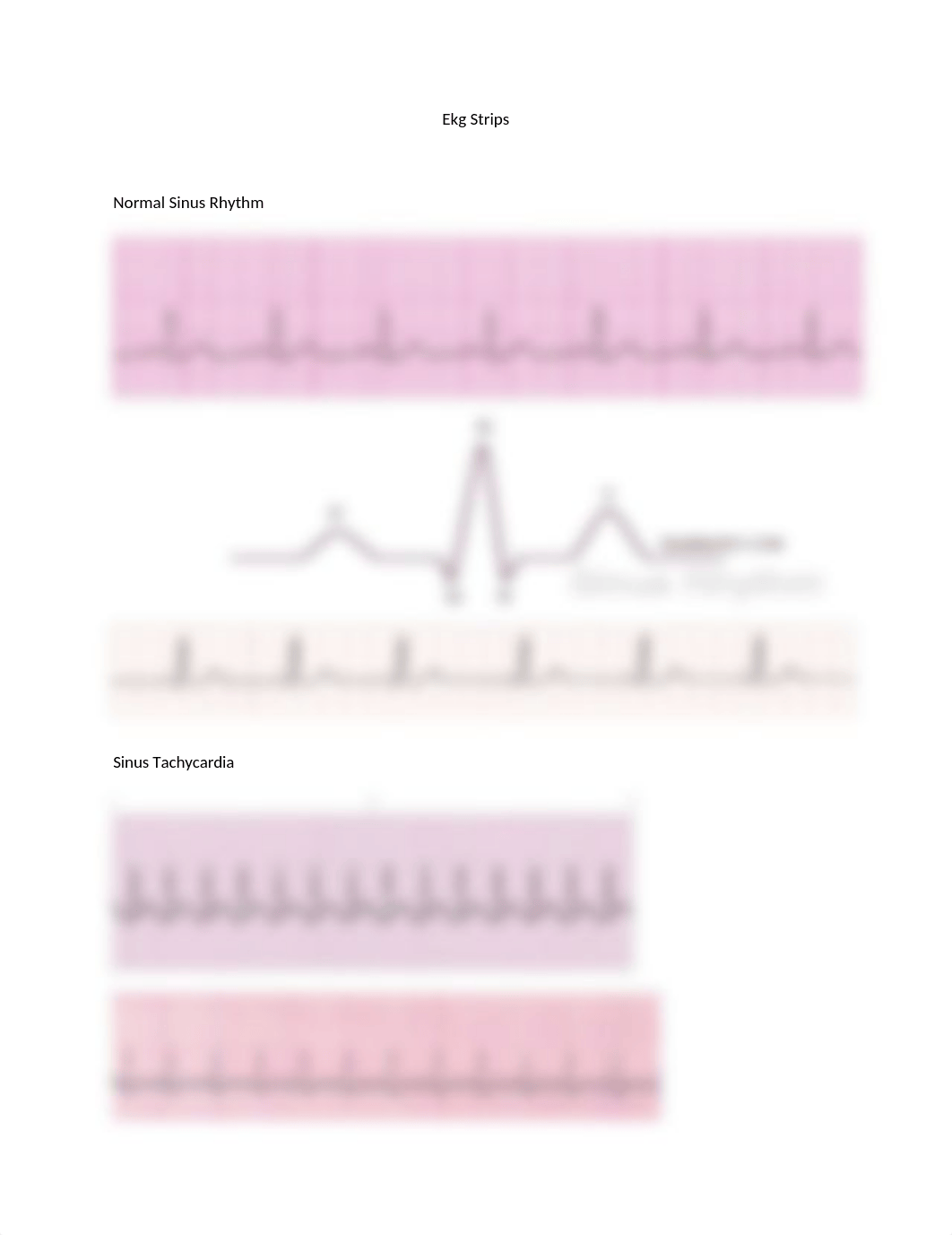 Ekg Strips.docx_d8b8wbk1d9j_page1