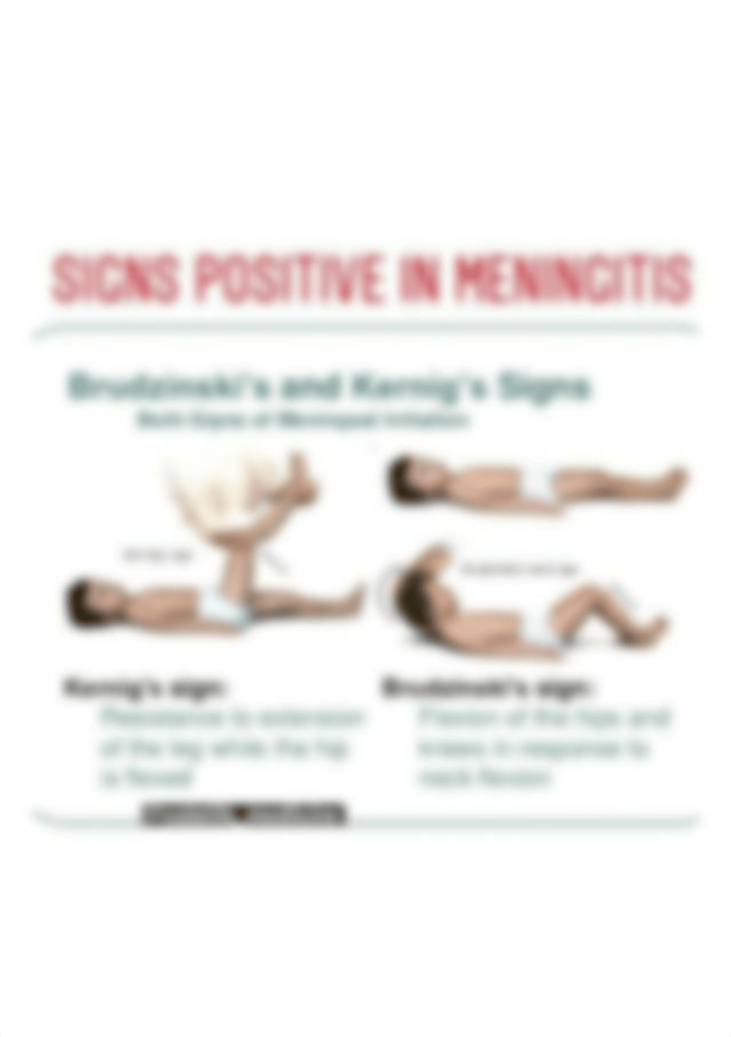 brudzinki and kernig sign.jpg_d8rxyrbh652_page1