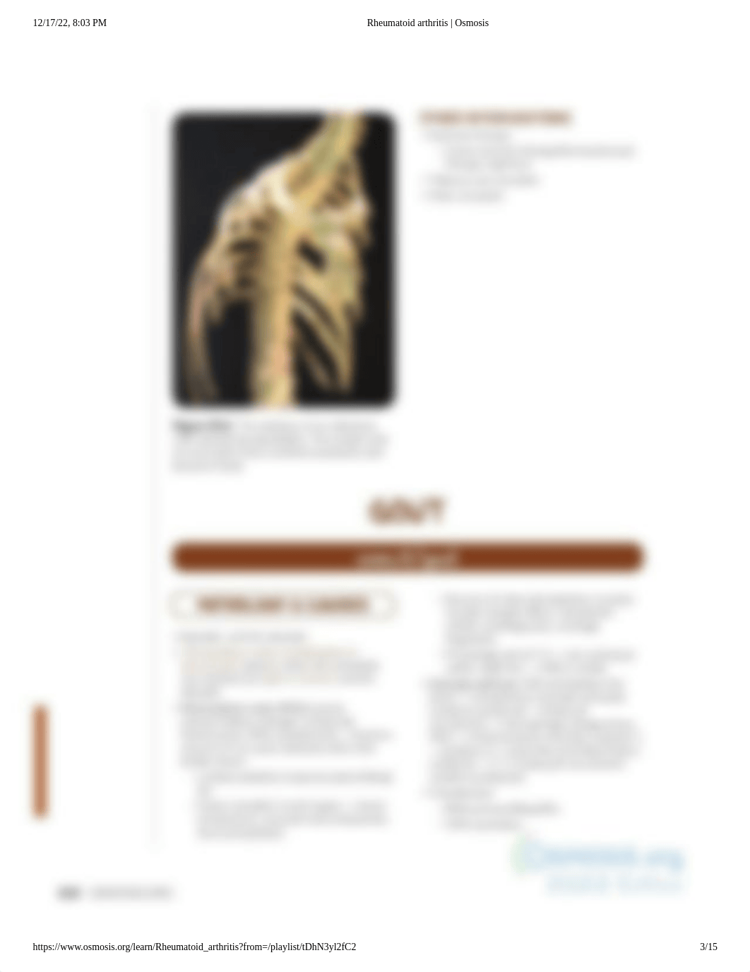 Rheumatoid arthritis _ Osmosis.pdf_dbboz33r3lc_page3