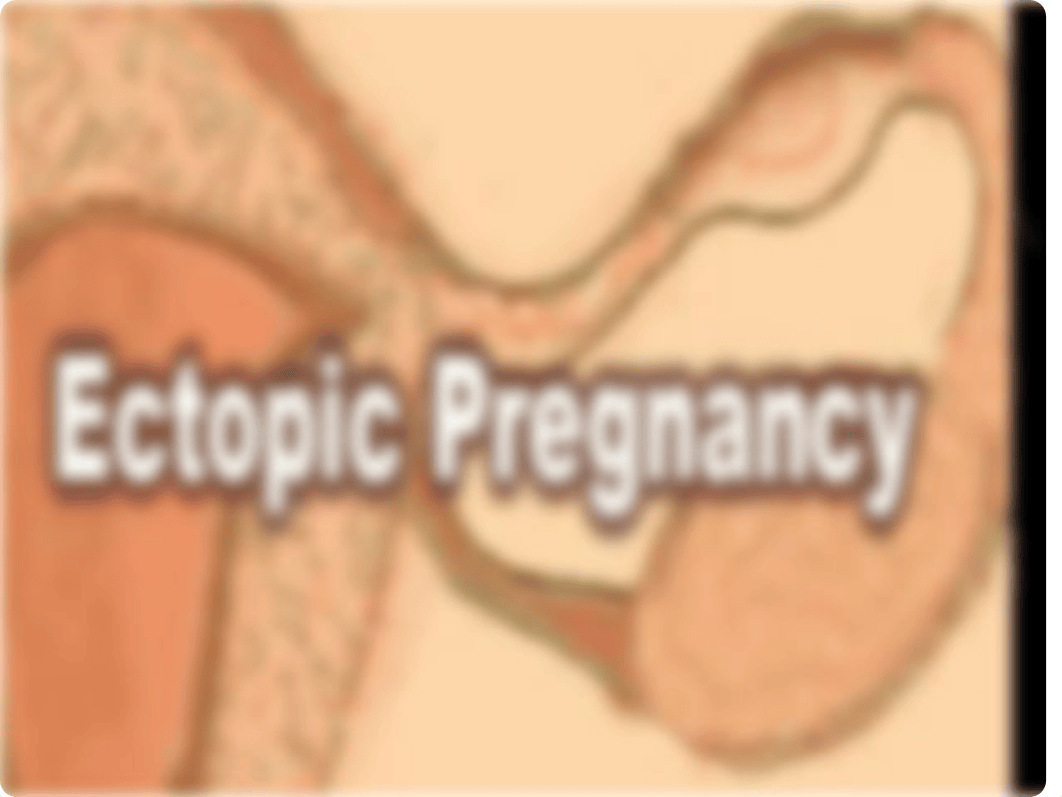 ECTOPIC  PREGNANCY.ppt_dbz03zvuqo1_page1