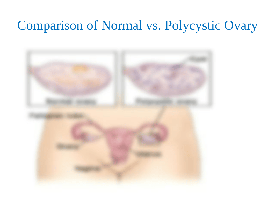 PCOS PowerPoint.pptx_dfivyv0fq6k_page4