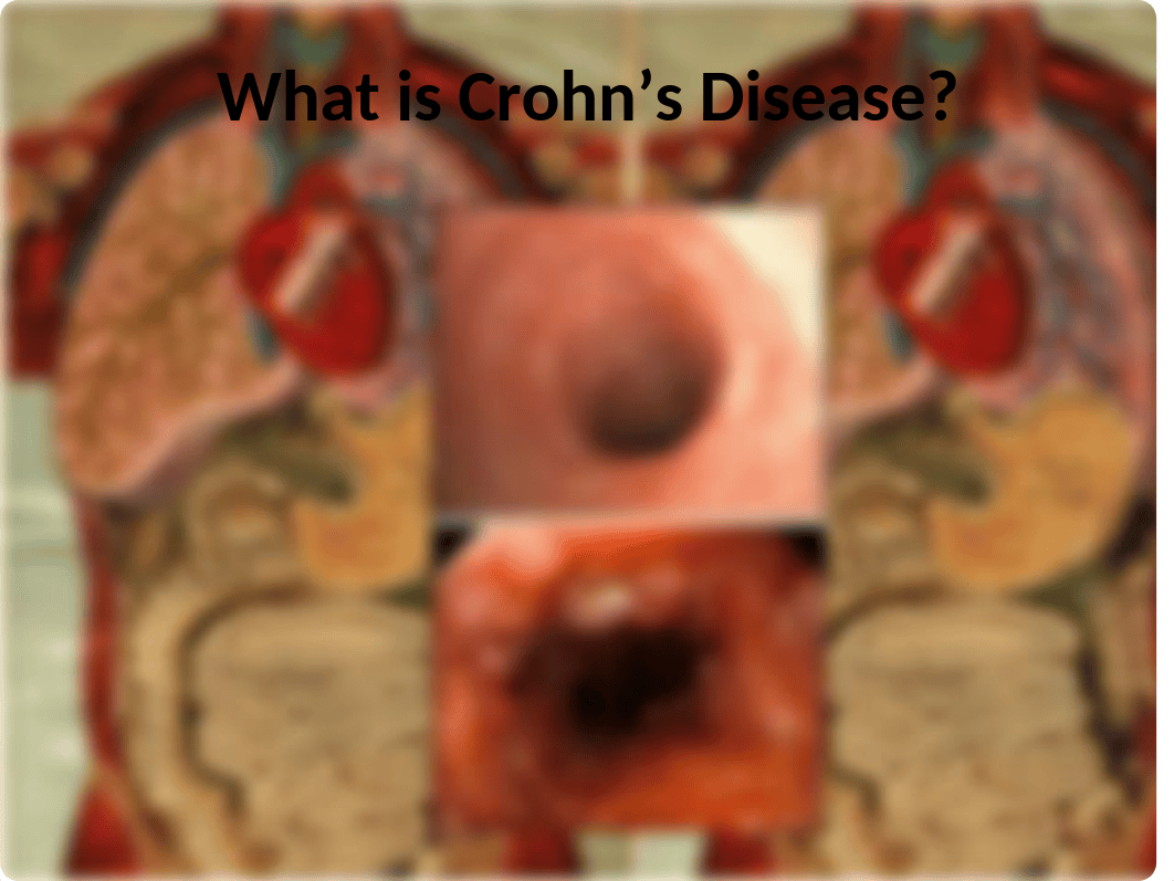 crohns-case-study student ppt.pptx_dfxvtg949t8_page2