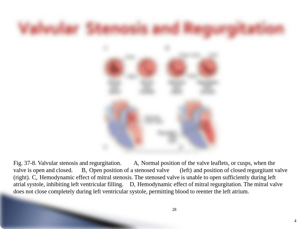 Chapter_28_Valvular_Heart_Disease_dgevkxr66gv_page4