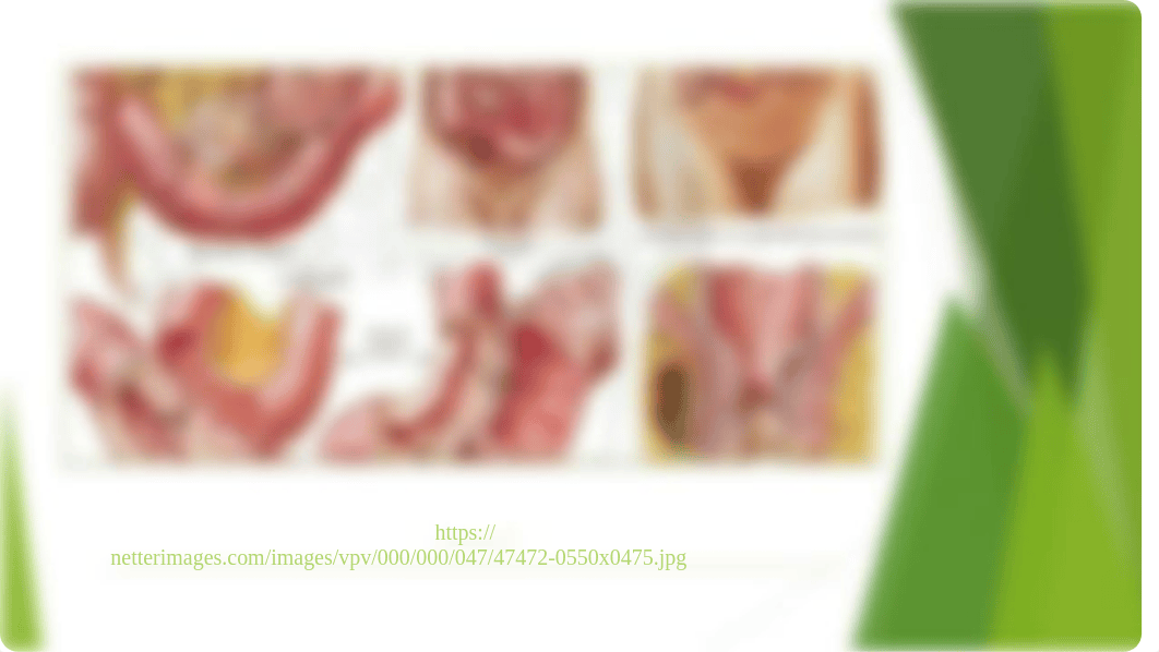 Crohns Disease PowerPoint_dn0is0zerq2_page5