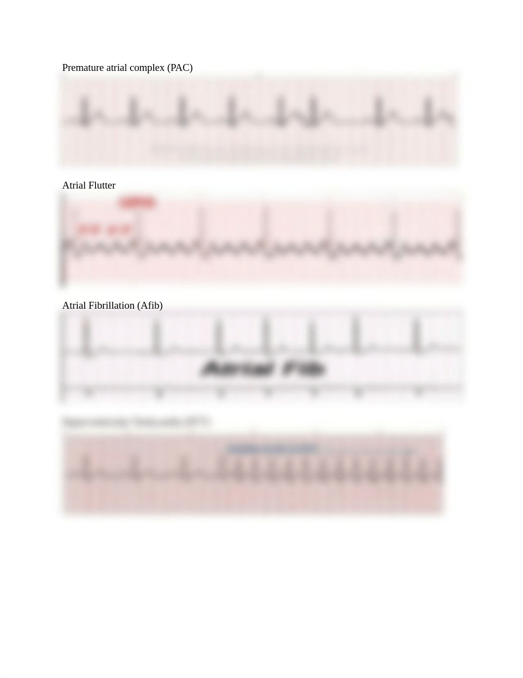 atrial dysrhythmias.docx_dn3qaj2usm3_page1