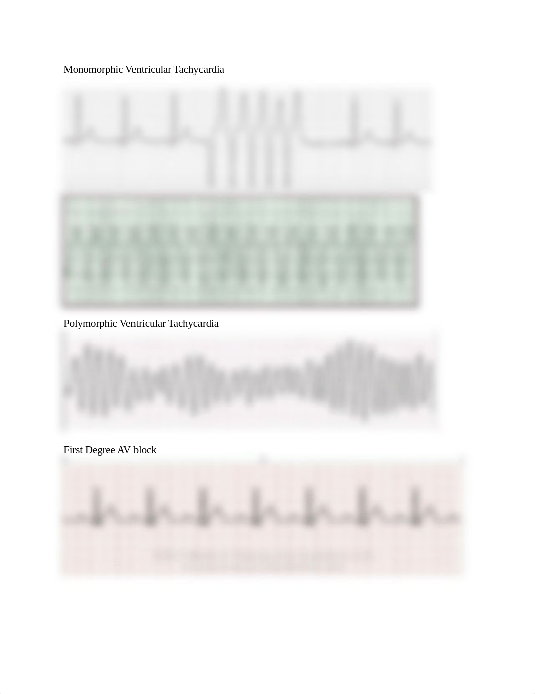 Ventricular Dysrhytmias .docx_dnxqghdwwuj_page2