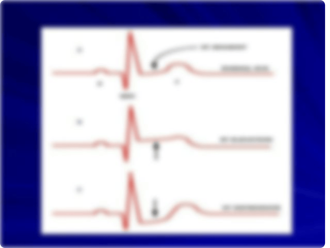 Unstable-angina-and-MI (1)_dp4v83w1pub_page2