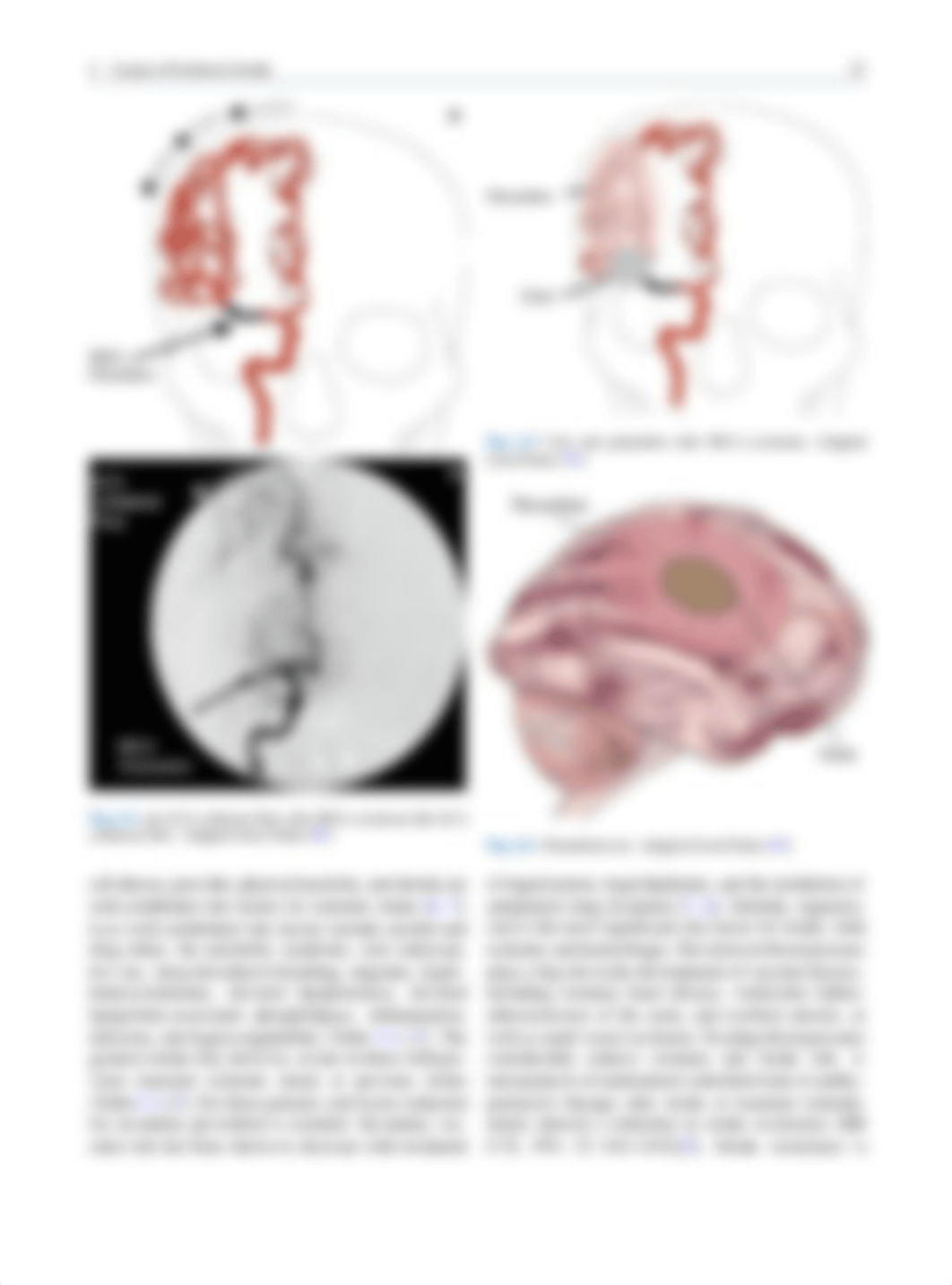 Causes_of_Ischemic_Stroke.pdf_dr36w8adwvf_page4