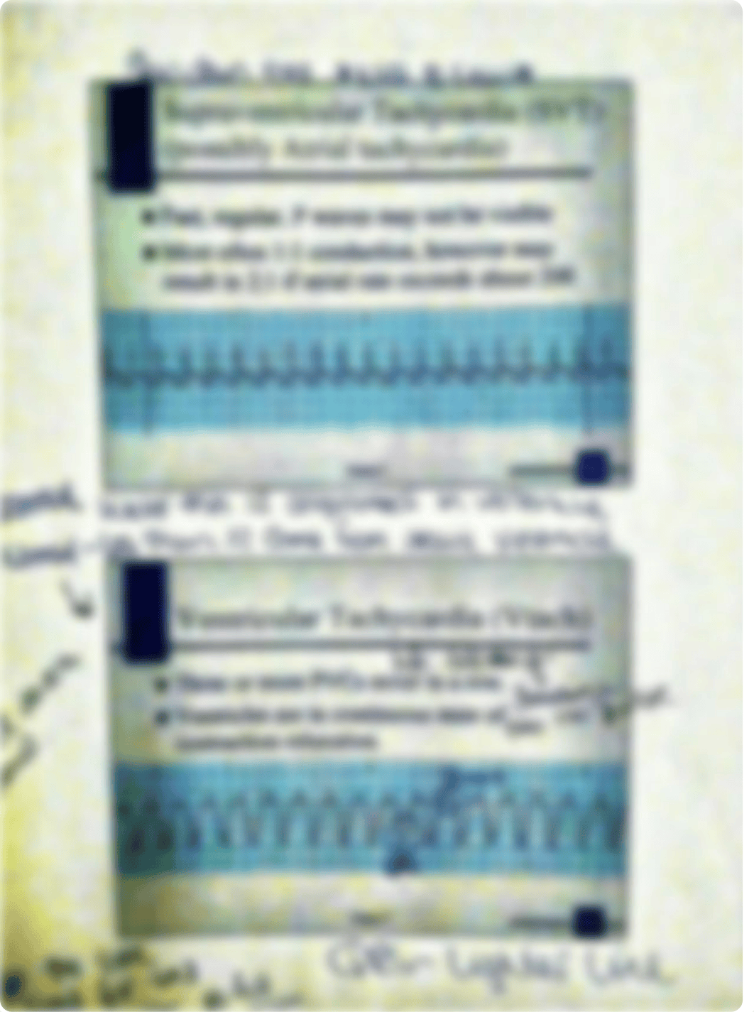 supraventricular tachycardia_dre2qm2x2ms_page1