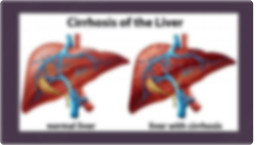 676 week 6 Cirrhosis.pptx_drtddvj8d5i_page2