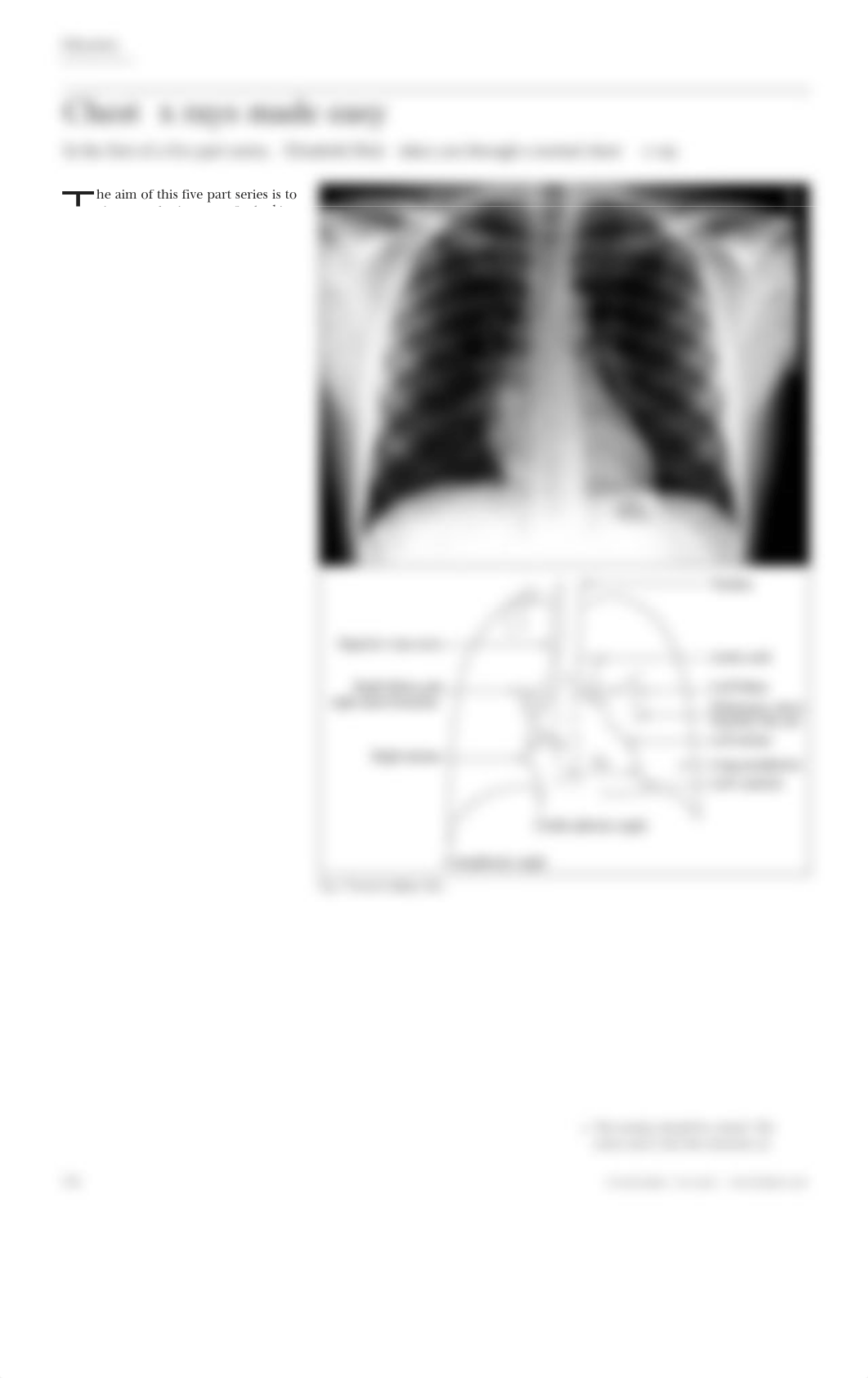 Chest x-ray made easy BMJ[All 5 articles].pdf_drznisn3sic_page1