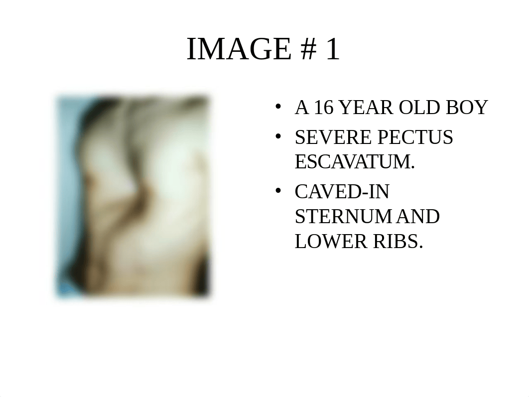 PECTUS EXCAVATUM.ppt_ds5atu5bwav_page3