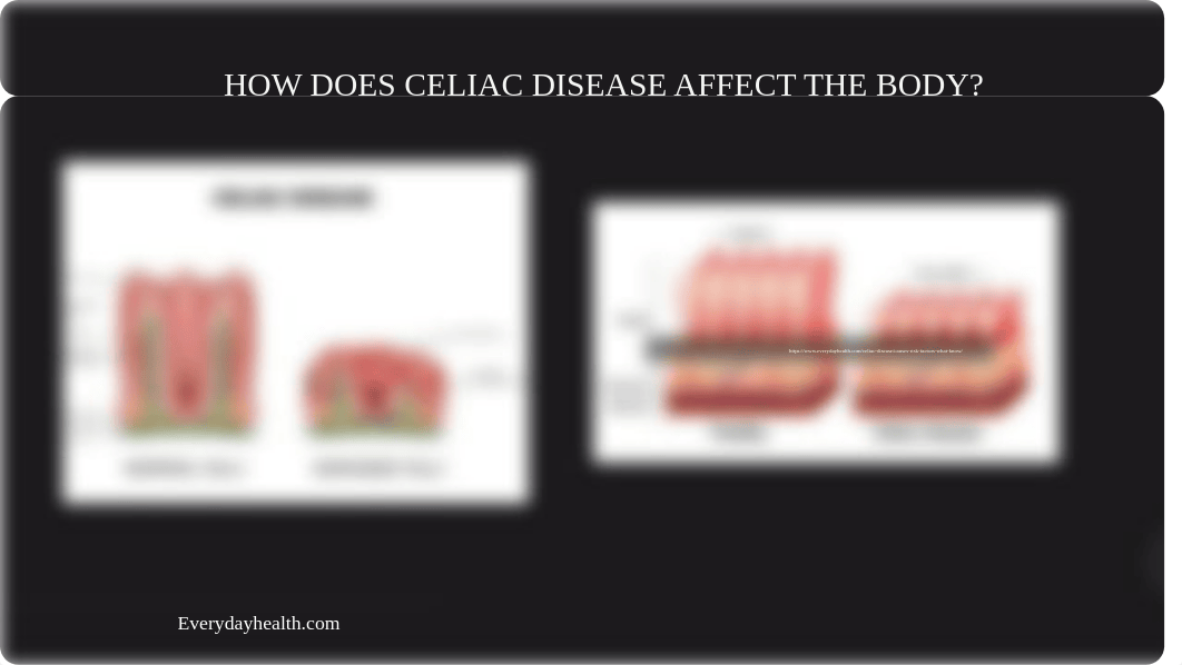 CELIAC DISEASE PRESENTATION 2020 SUMMER BIO 102.pptx_ds8nc5ewx2b_page5