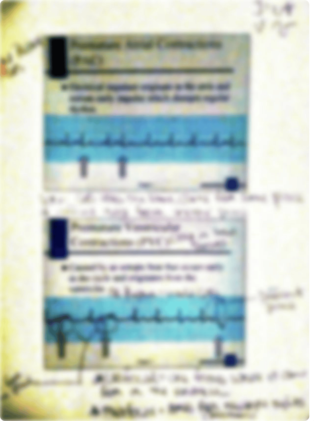 premature ventricular_dsjxg3ggmqm_page1