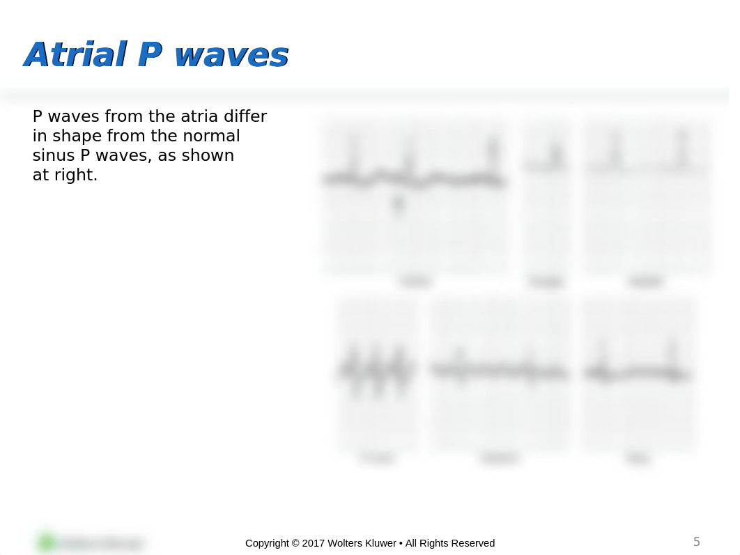 Ch 7 Atrial Arrhythmias.pptx_dunnhe1nwxv_page5