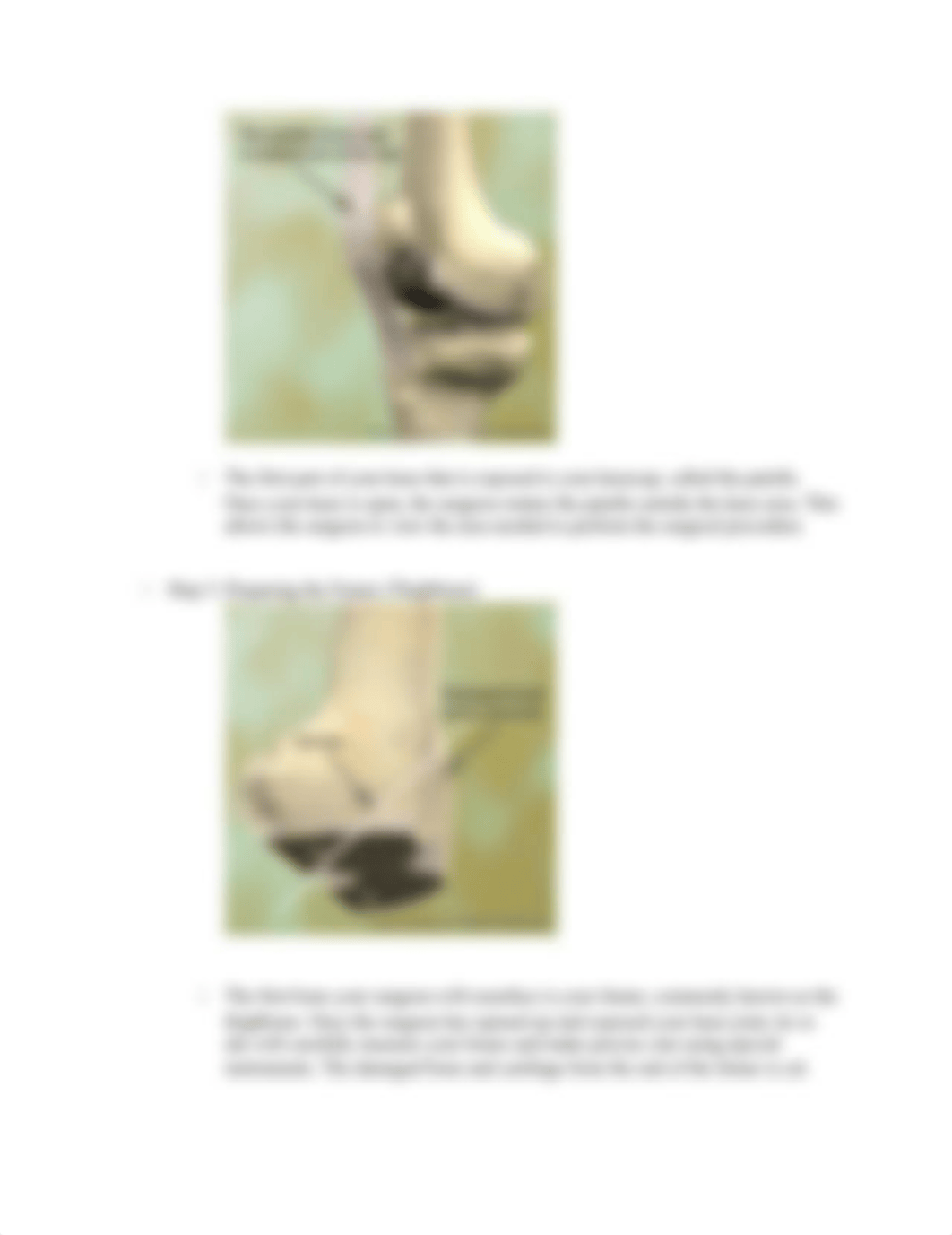 knee replacement surgery_duzu28rs8n0_page2