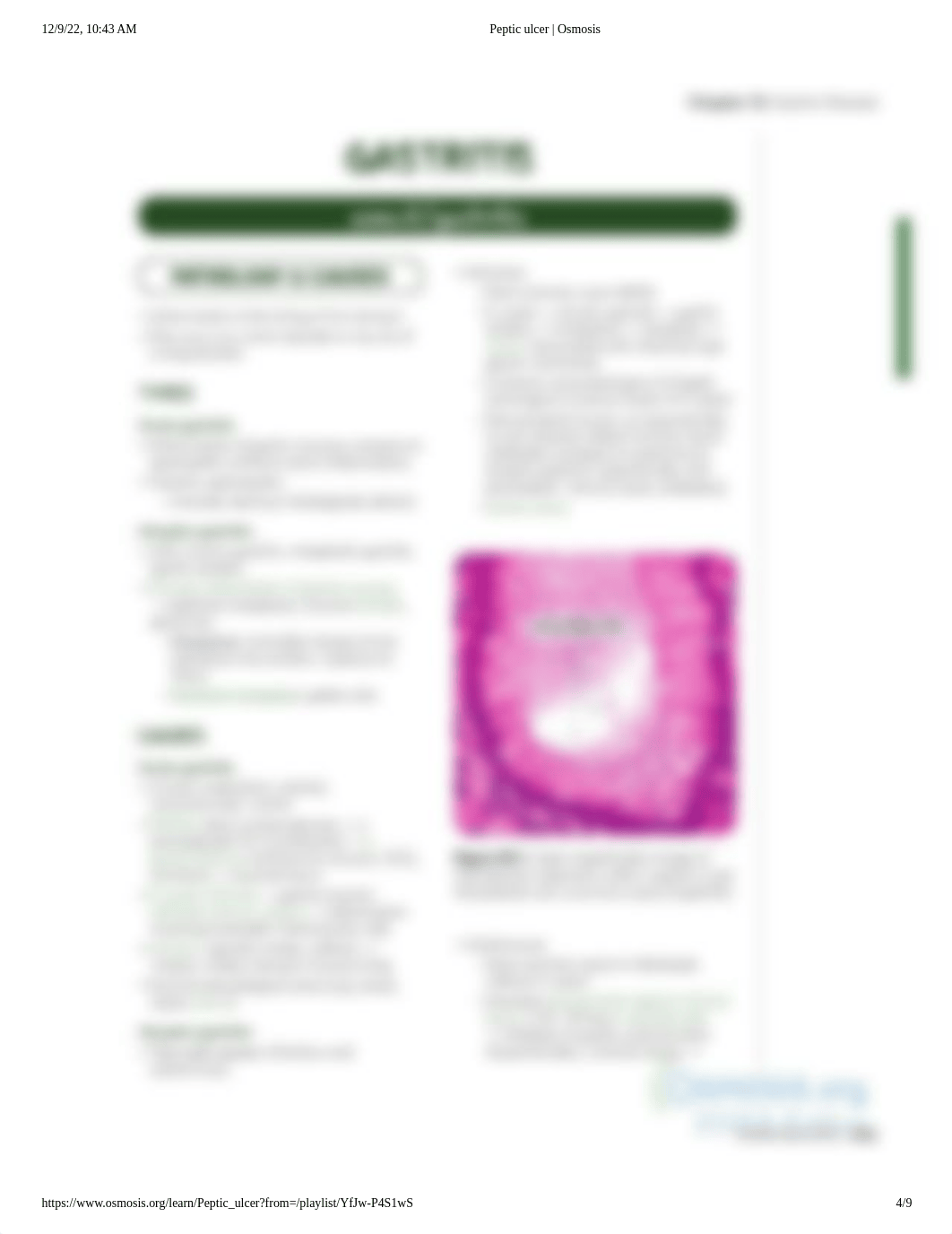 Peptic ulcer _ Osmosis.pdf_dvcsn8ilfen_page4