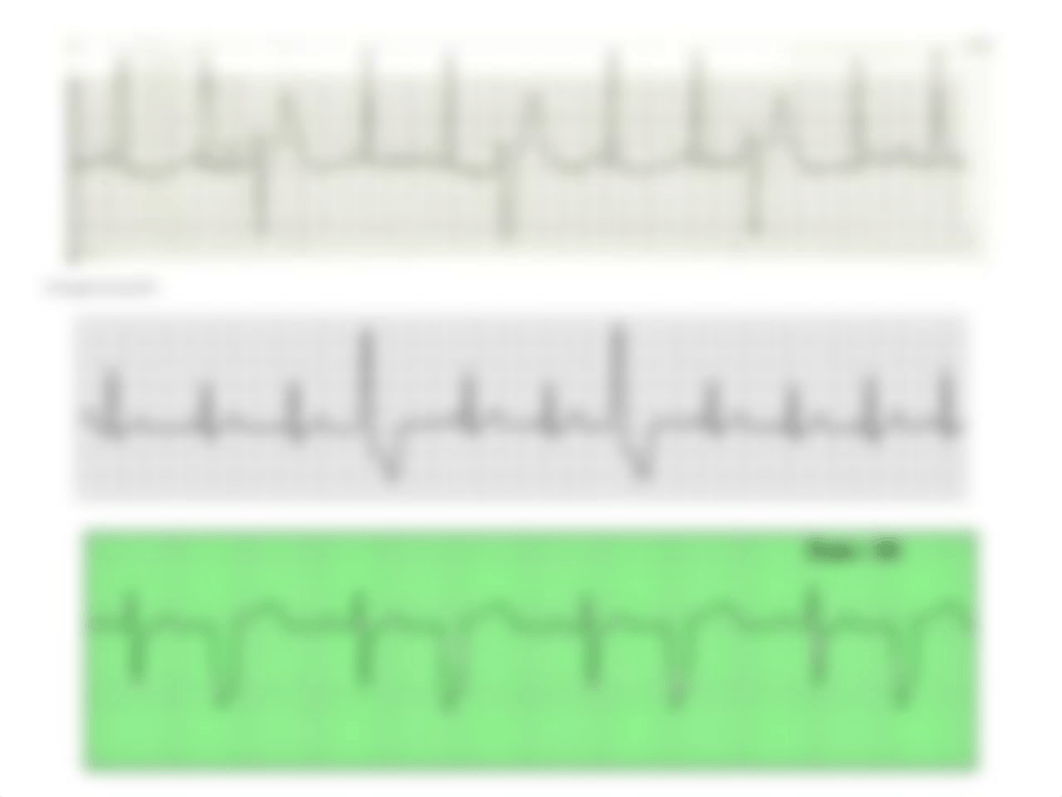 ECG part II.pptx_dylj5sip8nb_page5