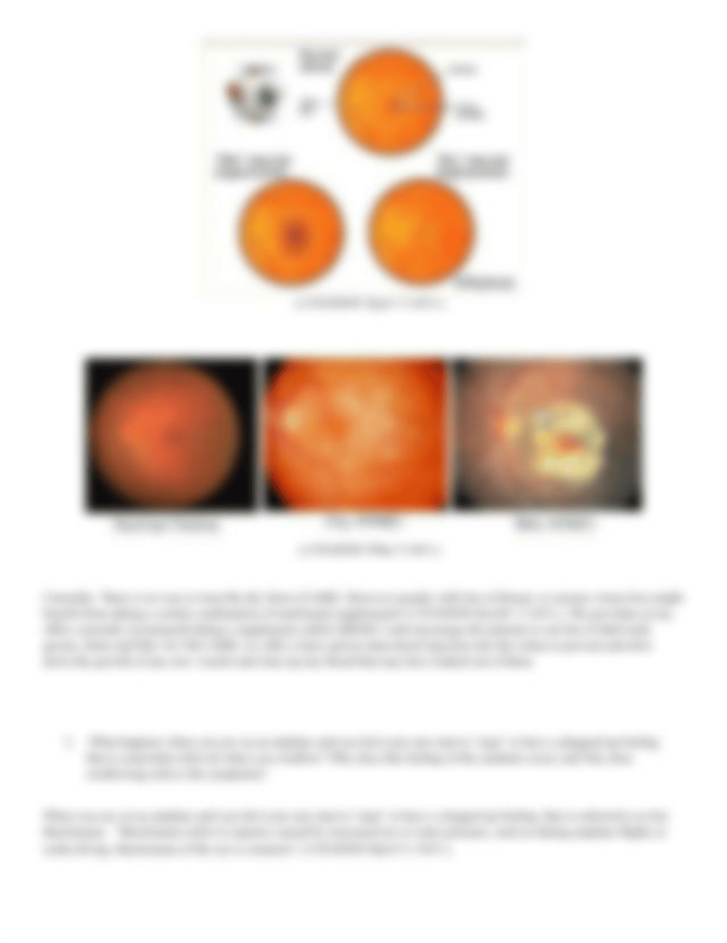 Macular Degen Assignment.docx_dz260gqbk07_page2