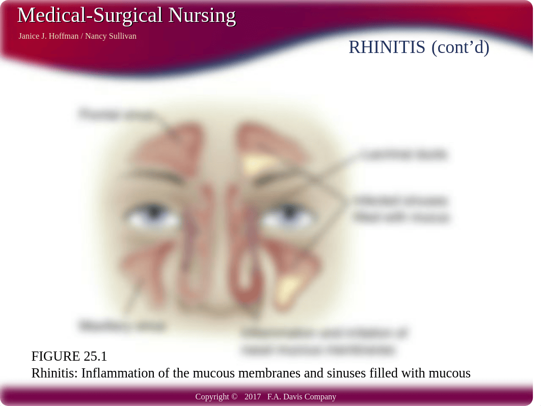 Med Surg CH25 S Coordinating Care for pts with Upper Airway Disorders.pptx_dzqajd7c4u6_page4