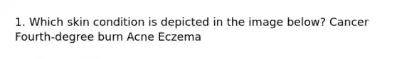 1. Which skin condition is depicted in the image below? Cancer Fourth-degree burn Acne Eczema