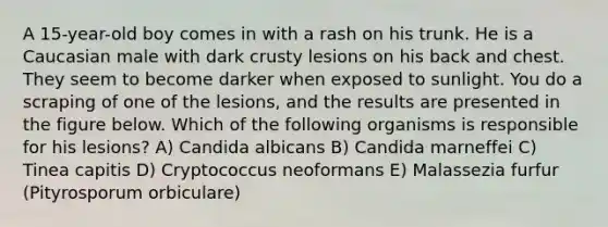 A 15-year-old boy comes in with a rash on his trunk. He is a Caucasian male with dark crusty lesions on his back and chest. They seem to become darker when exposed to sunlight. You do a scraping of one of the lesions, and the results are presented in the figure below. Which of the following organisms is responsible for his lesions? A) Candida albicans B) Candida marneffei C) Tinea capitis D) Cryptococcus neoformans E) Malassezia furfur (Pityrosporum orbiculare)