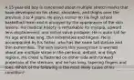 A 15-year-old boy is concerned about multiple stretch marks that have developed on his chest, shoulders, and thighs over the previous 3 to 4 years. He plays center on his high school basketball team and is annoyed by the appearance of the skin lesions. His medical history is remarkable for myopia, upward lens displacement, and mitral valve prolapse. He is quite tall for his age and has long, thin extremities and fingers. He is accompanied by his father, who has the same tall stature and thin extremities. The skin lesions this young man is worried about are multiple striae in the pectoral, deltoid, and thigh regions. His chest is flattened on either side with forward projection of the sternum, and he has long, tapering fingers and toes. Which of the following is the most likely cause of his condition?