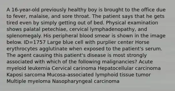 A 16-year-old previously healthy boy is brought to the office due to fever, malaise, and sore throat. The patient says that he gets tired even by simply getting out of bed. Physical examination shows palatal petechiae, cervical lymphadenopathy, and splenomegaly. His peripheral blood smear is shown in the image below. ID=1757 Large blue cell with purplier center Horse erythrocytes agglutinate when exposed to the patient's serum. The agent causing this patient's disease is most strongly associated with which of the following malignancies? Acute myeloid leukemia Cervical carinoma Hepatocellular carcinoma Kaposi sarcoma Mucosa-associated lymphoid tissue tumor Multiple myeloma Nasopharyngeal carcinoma