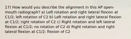 17) How would you describe the alignment in this AP open-mouth radiograph? a) Left rotation and right lateral flexion at C1/2; left rotation of C2 b) Left rotation and right lateral flexion at C1/2; right rotation of C2 c) Right rotation and left lateral flexion at C1/2; no rotation of C2 d) Right rotation and right lateral flexion at C1/2; flexion of C2