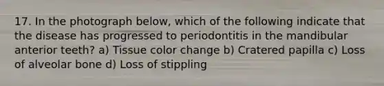 17. In the photograph below, which of the following indicate that the disease has progressed to periodontitis in the mandibular anterior teeth? a) Tissue color change b) Cratered papilla c) Loss of alveolar bone d) Loss of stippling