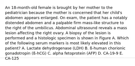 An 18-month-old female is brought by her mother to the pediatrician because the mother is concerned that her child's abdomen appears enlarged. On exam, the patient has a notably distended abdomen and a palpable firm mass-like structure to the right of the umbilicus. Abdominal ultrasound reveals a mass lesion affecting the right ovary. A biopsy of the lesion is performed and a histologic specimen is shown in Figure A. Which of the following serum markers is most likely elevated in this patient? A. Lactate dehydrogenase (LDH) B. ß-human chorionic gonadotropin (ß-hCG) C. alpha fetoprotein (AFP) D. CA-19-9 E. CA-125