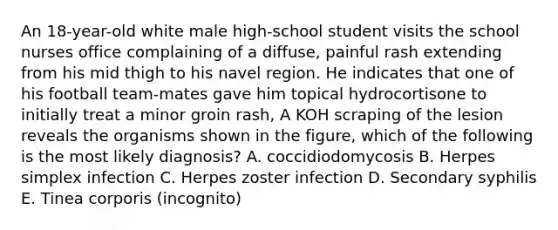 An 18-year-old white male high-school student visits the school nurses office complaining of a diffuse, painful rash extending from his mid thigh to his navel region. He indicates that one of his football team-mates gave him topical hydrocortisone to initially treat a minor groin rash, A KOH scraping of the lesion reveals the organisms shown in the figure, which of the following is the most likely diagnosis? A. coccidiodomycosis B. Herpes simplex infection C. Herpes zoster infection D. Secondary syphilis E. Tinea corporis (incognito)