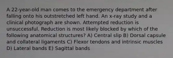 A 22-year-old man comes to the emergency department after falling onto his outstretched left hand. An x-ray study and a clinical photograph are shown. Attempted reduction is unsuccessful. Reduction is most likely blocked by which of the following anatomical structures? A) Central slip B) Dorsal capsule and collateral ligaments C) Flexor tendons and intrinsic muscles D) Lateral bands E) Sagittal bands
