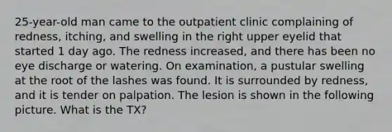 25-year-old man came to the outpatient clinic complaining of redness, itching, and swelling in the right upper eyelid that started 1 day ago. The redness increased, and there has been no eye discharge or watering. On examination, a pustular swelling at the root of the lashes was found. It is surrounded by redness, and it is tender on palpation. The lesion is shown in the following picture. What is the TX?