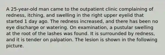 A 25-year-old man came to the outpatient clinic complaining of redness, itching, and swelling in the right upper eyelid that started 1 day ago. The redness increased, and there has been no eye discharge or watering. On examination, a pustular swelling at the root of the lashes was found. It is surrounded by redness, and it is tender on palpation. The lesion is shown in the following picture.