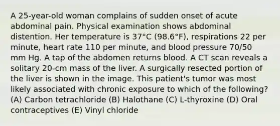 A 25-year-old woman complains of sudden onset of acute abdominal pain. Physical examination shows abdominal distention. Her temperature is 37°C (98.6°F), respirations 22 per minute, heart rate 110 per minute, and blood pressure 70/50 mm Hg. A tap of the abdomen returns blood. A CT scan reveals a solitary 20-cm mass of the liver. A surgically resected portion of the liver is shown in the image. This patient's tumor was most likely associated with chronic exposure to which of the following? (A) Carbon tetrachloride (B) Halothane (C) L-thyroxine (D) Oral contraceptives (E) Vinyl chloride