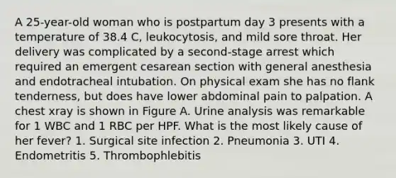 A 25-year-old woman who is postpartum day 3 presents with a temperature of 38.4 C, leukocytosis, and mild sore throat. Her delivery was complicated by a second-stage arrest which required an emergent cesarean section with general anesthesia and endotracheal intubation. On physical exam she has no flank tenderness, but does have lower abdominal pain to palpation. A chest xray is shown in Figure A. Urine analysis was remarkable for 1 WBC and 1 RBC per HPF. What is the most likely cause of her fever? 1. Surgical site infection 2. Pneumonia 3. UTI 4. Endometritis 5. Thrombophlebitis