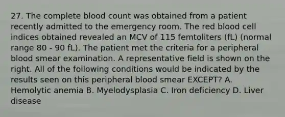 27. The complete blood count was obtained from a patient recently admitted to the emergency room. The red blood cell indices obtained revealed an MCV of 115 femtoliters (fL) (normal range 80 - 90 fL). The patient met the criteria for a peripheral blood smear examination. A representative field is shown on the right. All of the following conditions would be indicated by the results seen on this peripheral blood smear EXCEPT? A. Hemolytic anemia B. Myelodysplasia C. Iron deficiency D. Liver disease