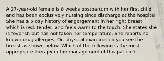 A 27-year-old female is 8 weeks postpartum with her first child and has been exclusively nursing since discharge at the hospital. She has a 5-day history of engorgement in her right breast, which is red, tender, and feels warm to the touch. She states she is feverish but has not taken her temperature. She reports no known drug allergies. On physical examination you see the breast as shown below. Which of the following is the most appropriate therapy in the management of this patient?