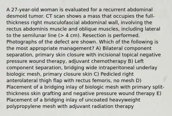 A 27-year-old woman is evaluated for a recurrent abdominal desmoid tumor. CT scan shows a mass that occupies the full-thickness right musculofascial abdominal wall, involving the rectus abdominis muscle and oblique muscles, including lateral to the semilunar line (> 4 cm). Resection is performed. Photographs of the defect are shown. Which of the following is the most appropriate management? A) Bilateral component separation, primary skin closure with incisional topical negative pressure wound therapy, adjuvant chemotherapy B) Left component separation, bridging wide intraperitoneal underlay biologic mesh, primary closure skin C) Pedicled right anterolateral thigh flap with rectus femoris, no mesh D) Placement of a bridging inlay of biologic mesh with primary split-thickness skin grafting and negative pressure wound therapy E) Placement of a bridging inlay of uncoated heavyweight polypropylene mesh with adjuvant radiation therapy