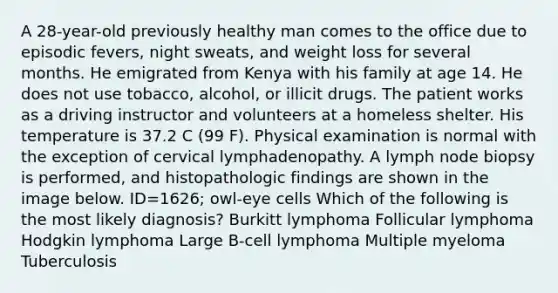 A 28-year-old previously healthy man comes to the office due to episodic fevers, night sweats, and weight loss for several months. He emigrated from Kenya with his family at age 14. He does not use tobacco, alcohol, or illicit drugs. The patient works as a driving instructor and volunteers at a homeless shelter. His temperature is 37.2 C (99 F). Physical examination is normal with the exception of cervical lymphadenopathy. A lymph node biopsy is performed, and histopathologic findings are shown in the image below. ID=1626; owl-eye cells Which of the following is the most likely diagnosis? Burkitt lymphoma Follicular lymphoma Hodgkin lymphoma Large B-cell lymphoma Multiple myeloma Tuberculosis