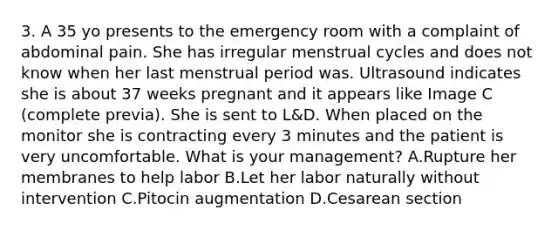 3. A 35 yo presents to the emergency room with a complaint of abdominal pain. She has irregular menstrual cycles and does not know when her last menstrual period was. Ultrasound indicates she is about 37 weeks pregnant and it appears like Image C (complete previa). She is sent to L&D. When placed on the monitor she is contracting every 3 minutes and the patient is very uncomfortable. What is your management? A.Rupture her membranes to help labor B.Let her labor naturally without intervention C.Pitocin augmentation D.Cesarean section